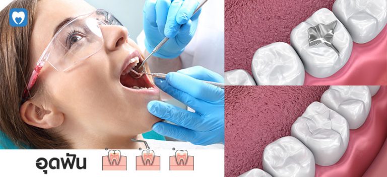 อุดฟัน_dental-filling-768x352.jpg